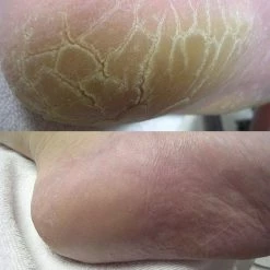 Alternative view of Groothandel ???? Footlogix Cracked Heel Formula ????